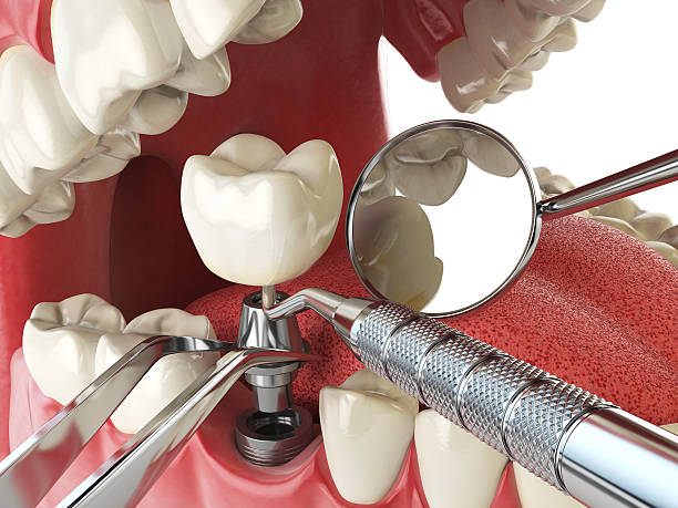 Best Emergency Dental Care for Broken or Chipped Teeth in Kure Beach, NC